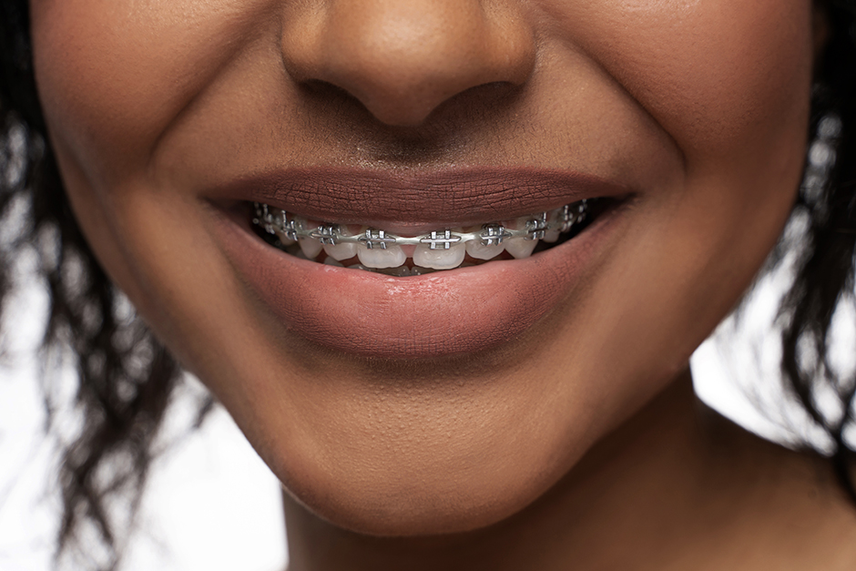 Orthodontics concept. Closeup of black woman's smile with a dental braces on teeth.